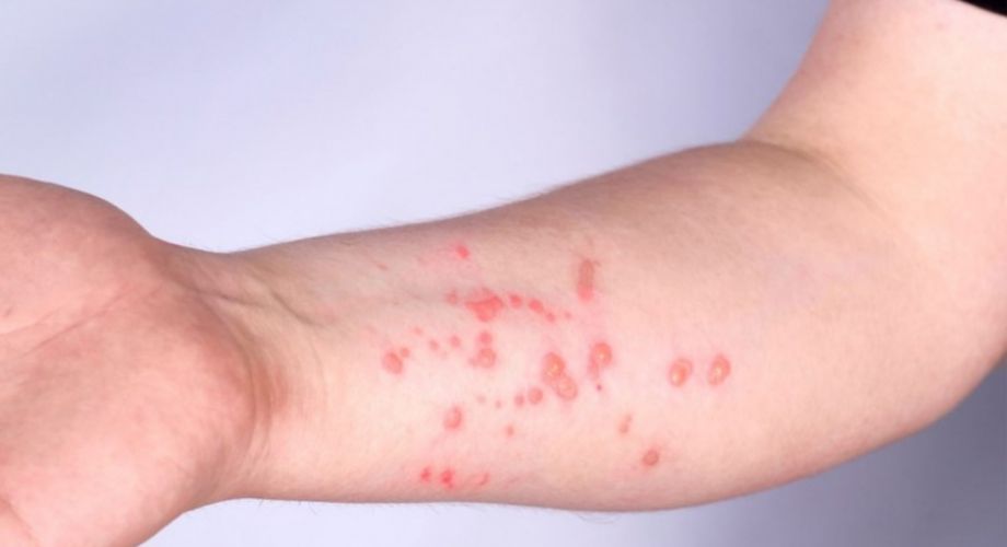 Primeiro caso de mpox na região é registrado em Passo Fundo