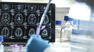 Anvisa aprova 1º tratamento que promete retardar Alzheimer