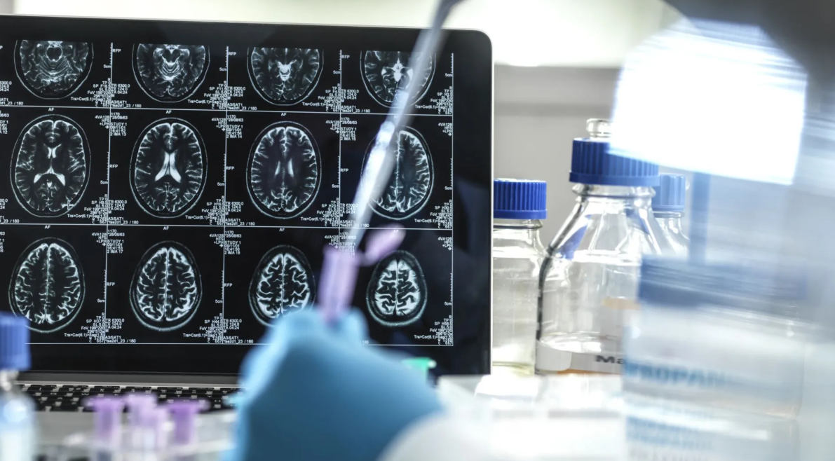 Anvisa aprova 1º tratamento que promete retardar Alzheimer