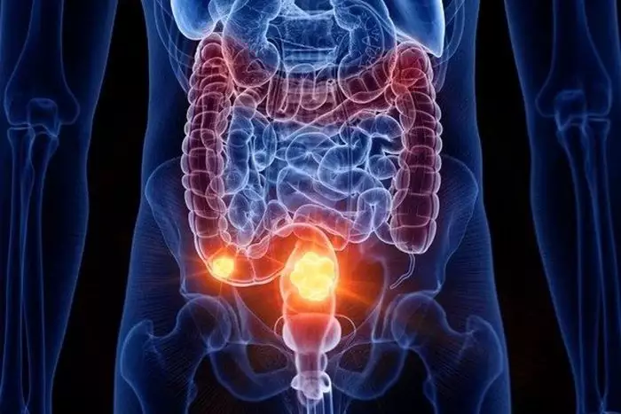 Câncer de intestino: entenda por que a doença está acometendo cada vez mais os jovens