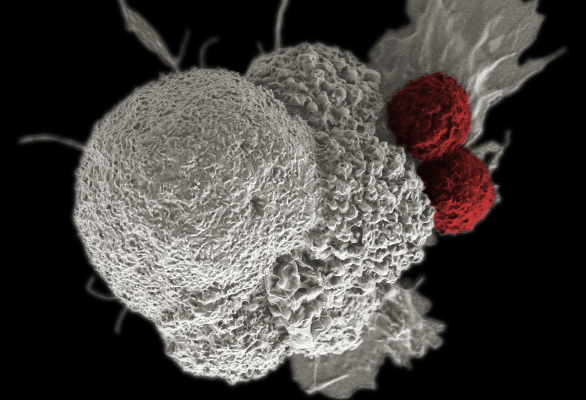 Estudo de CAR-T brasileiro elimina câncer em 72% dos pacientes