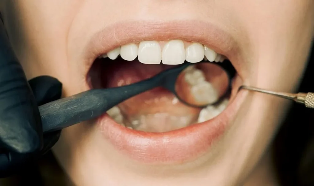 Uso regular de fio dental pode reduzir risco de AVC, aponta estudo