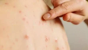 Brasil está em alerta máximo devido ao aumento de casos de sarampo nas Américas