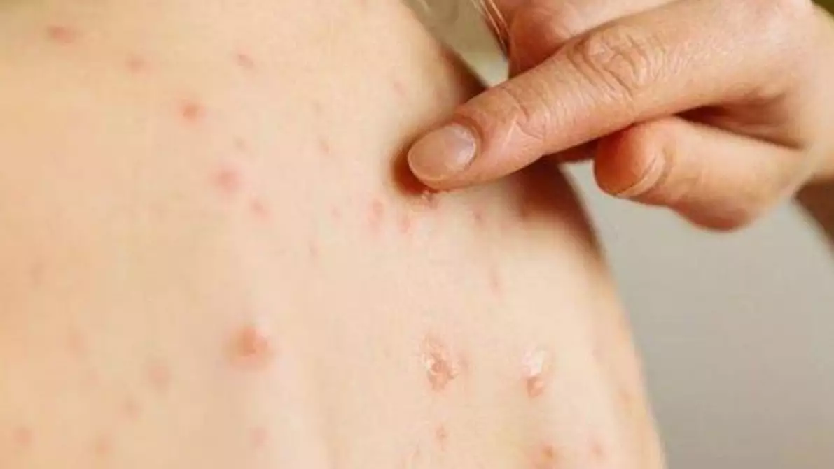 Brasil está em alerta máximo devido ao aumento de casos de sarampo nas Américas