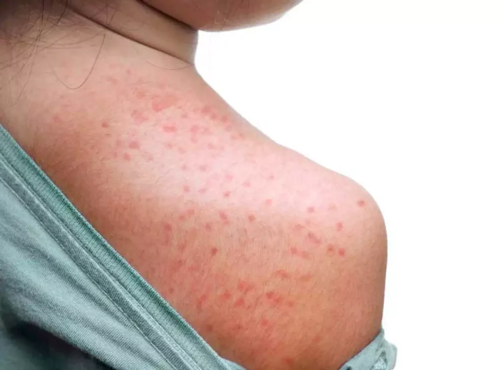 Com Copa do Mundo e férias internacionais, governo do RS amplia alerta para casos importados de sarampo