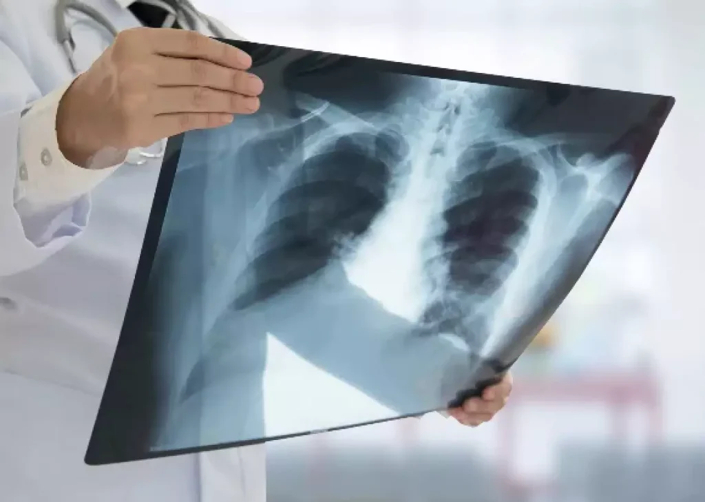 Hospitalizações por infecção respiratória aguda continuam em nível de alerta no RS e em outros Estados