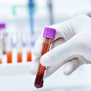 Exame de sangue para Alzheimer chega ao Brasil e custa cerca de R$ 3 mil