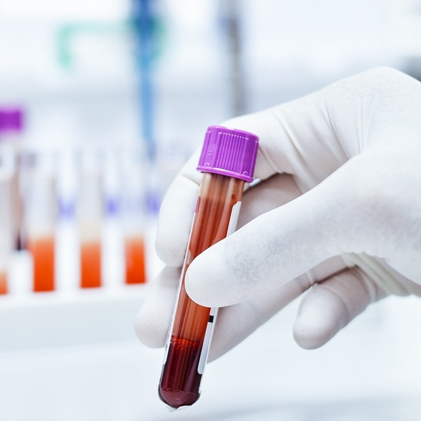 Exame de sangue para Alzheimer chega ao Brasil e custa cerca de R$ 3 mil